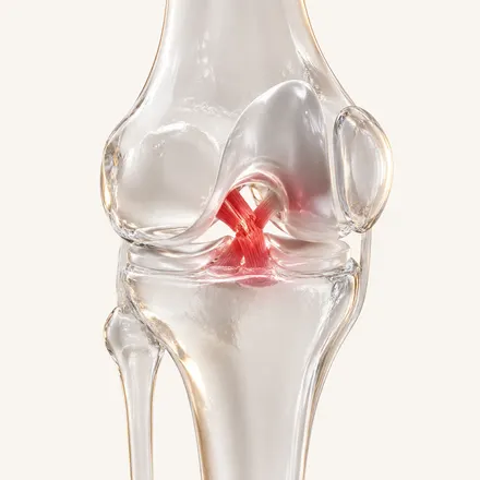 ACL Injury & Rehabilitation