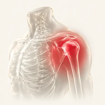 Frozen Shoulder
