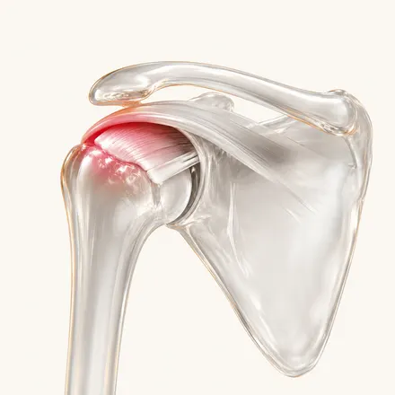 Rotator Cuff-related problems