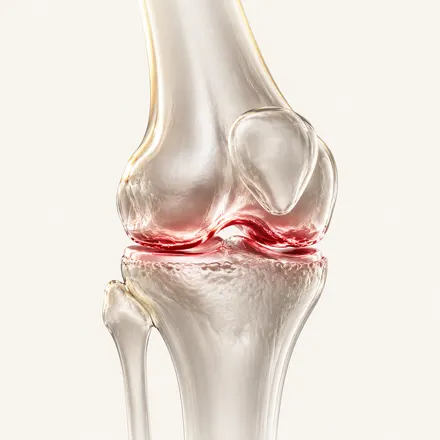 Knee Osteoarthritis